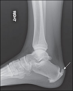 heel spur on back of ankle